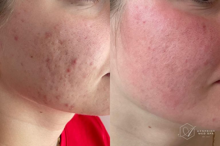 Acne scars before and after CO2 Laser Resurfacing