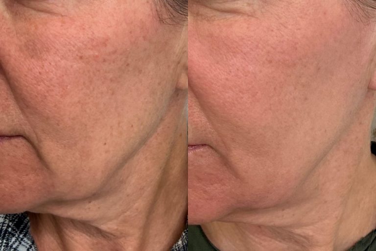 After single session of CO2 Skin Resurfacing for pigmentation and texture