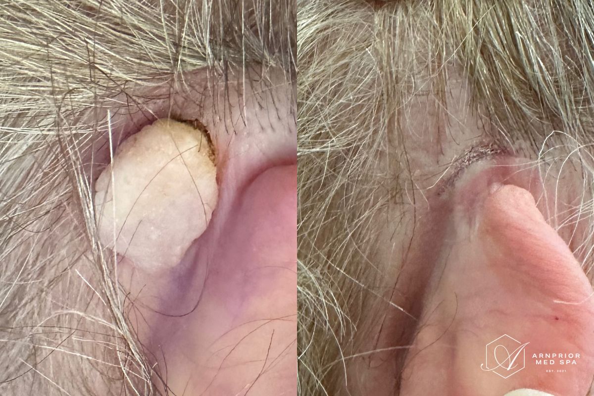 Benign lesion behind ear before and after Plexr plasma removal