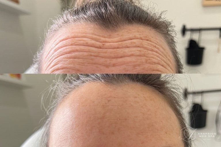 Forehead wrinkles before and after Dysport in Arnprior ON