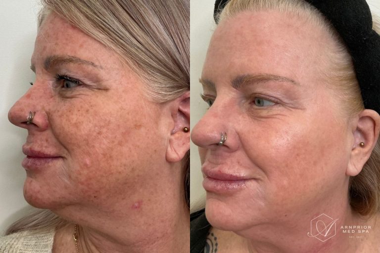 before and after CO2 Skin Resurfacing