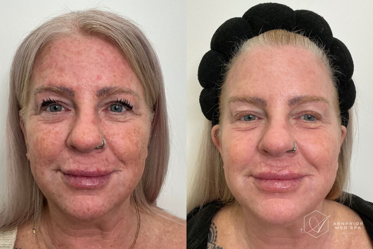 Dark spots before and after CO2 Skin Resurfacing