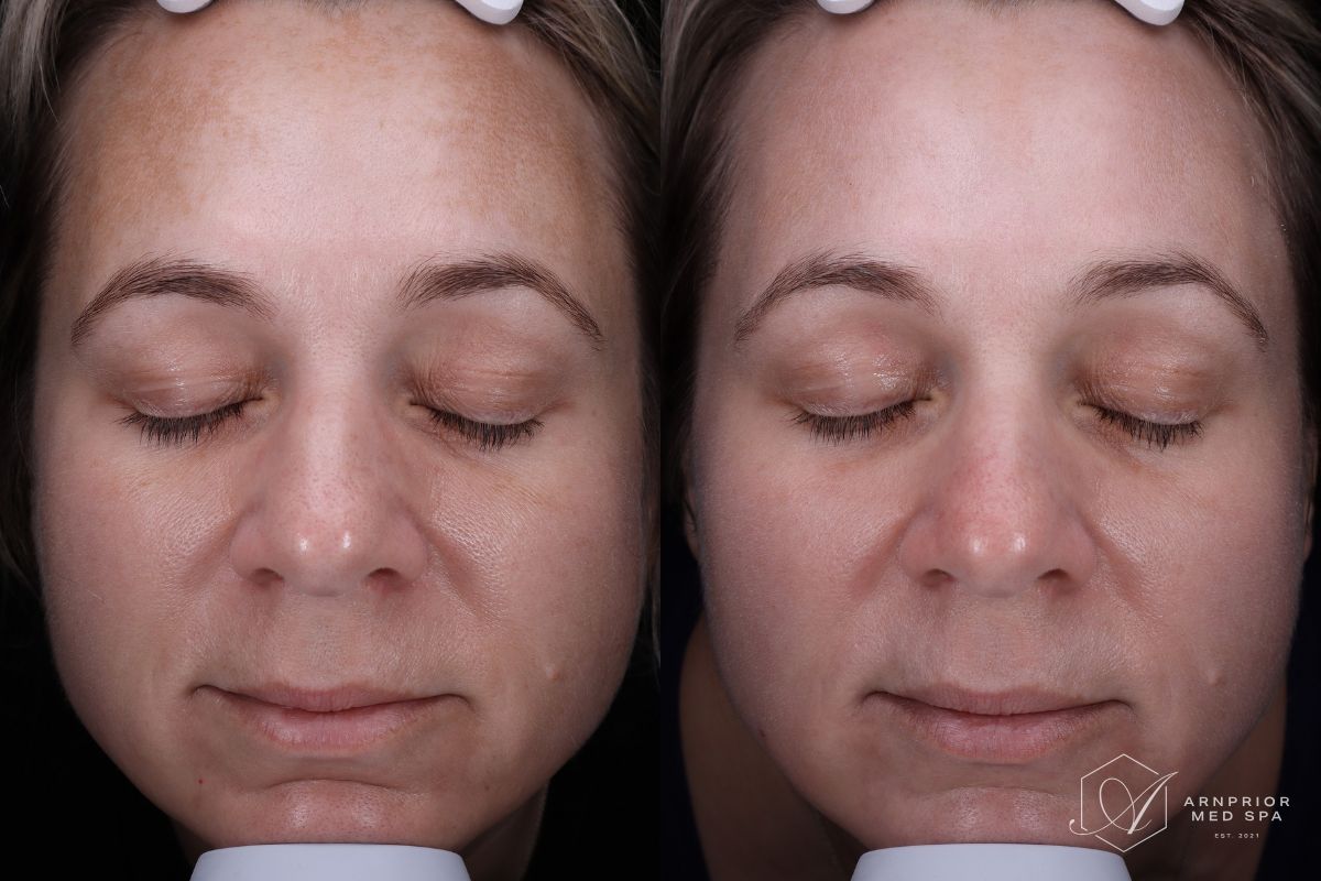 LaseMD Ultra Skin Resurfacing Melasma Hyperpigmentation