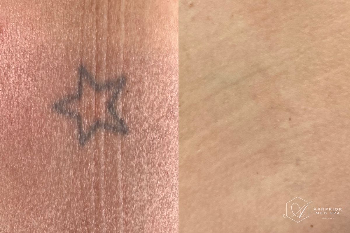 Laser tattoo removal before and after at Arnprior Med Spa