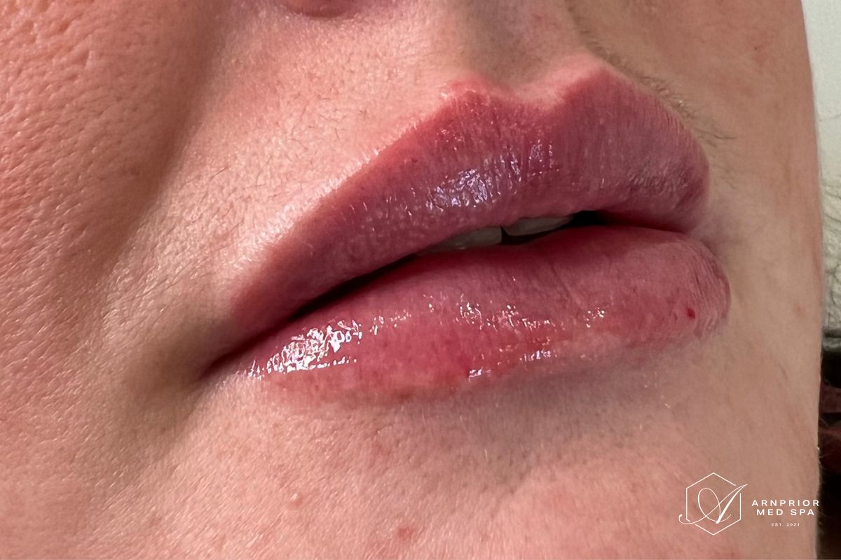 Lip filler after