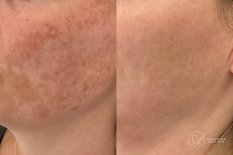 Melasma before and after laser toning treatment