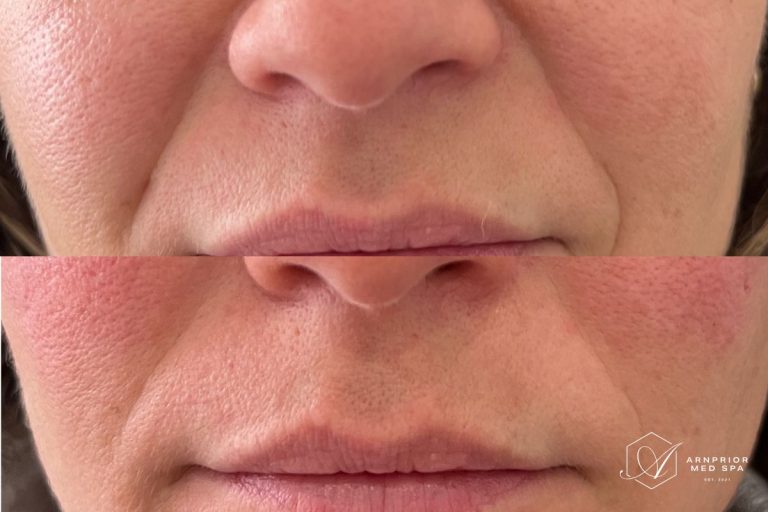 Nasolabial folds before and after lip filler