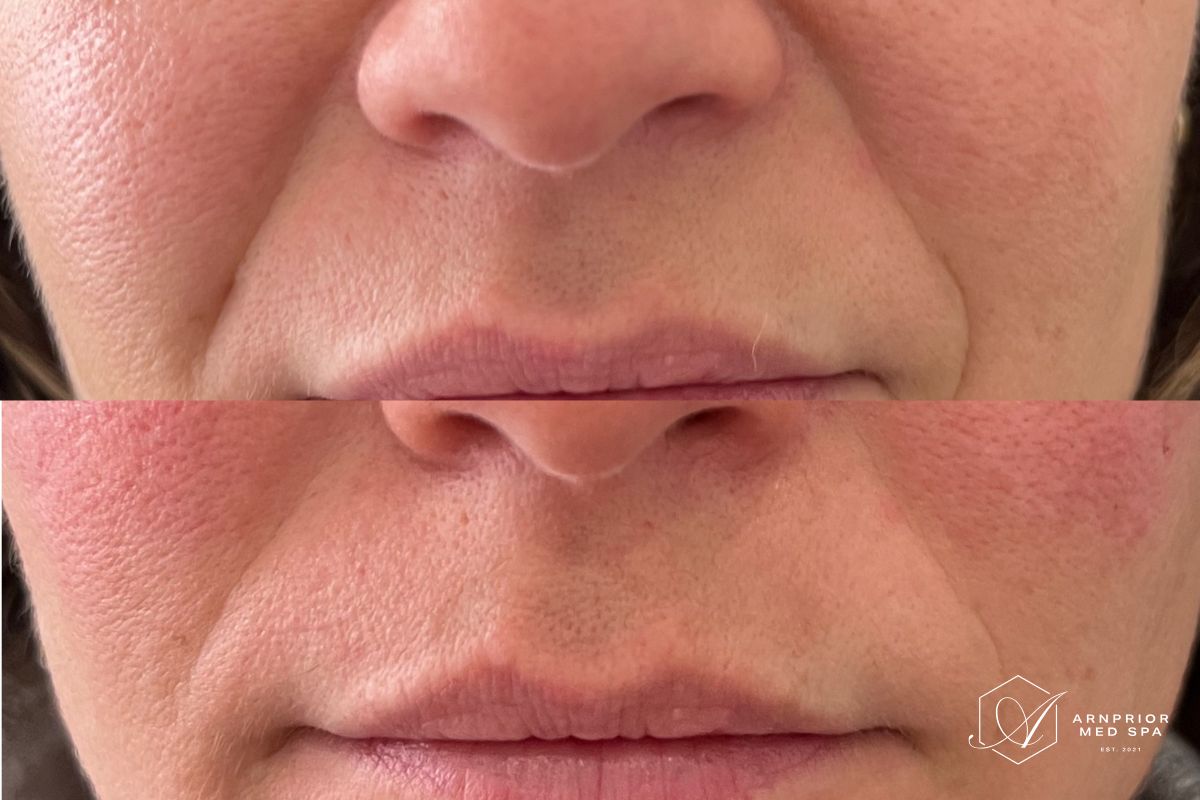 Nasolabial folds before and after lip filler