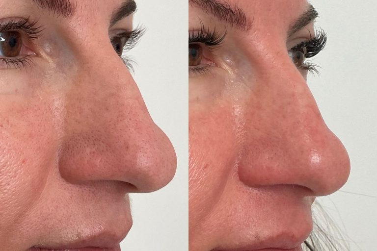 Pore refinement with CO2 Resurfacing