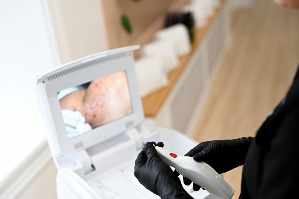 Plexr is a device preferred for skin tag and mole removal at Arnprior Med Spa