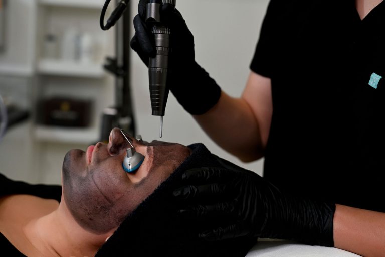 Hollywood Carbon Laser Peel