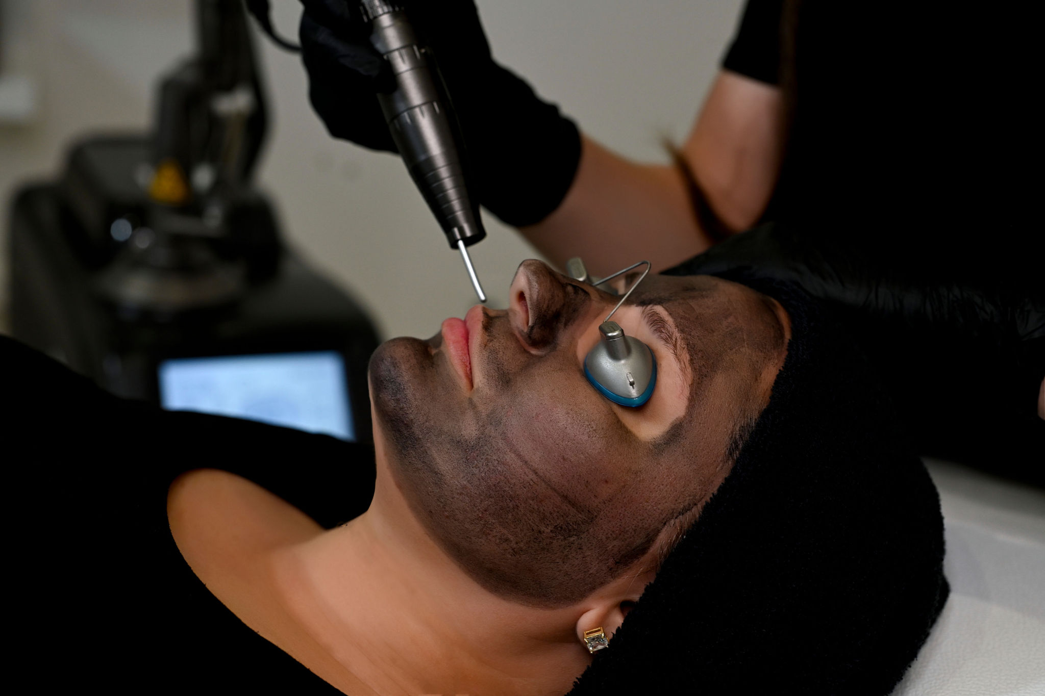 hollywood carbon laser peel in arnprior ontario