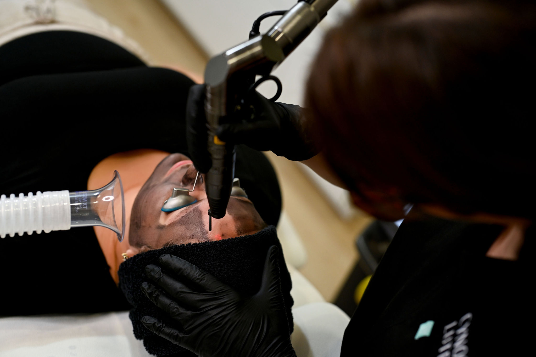 hollywood carbon laser peel in arnprior ontario