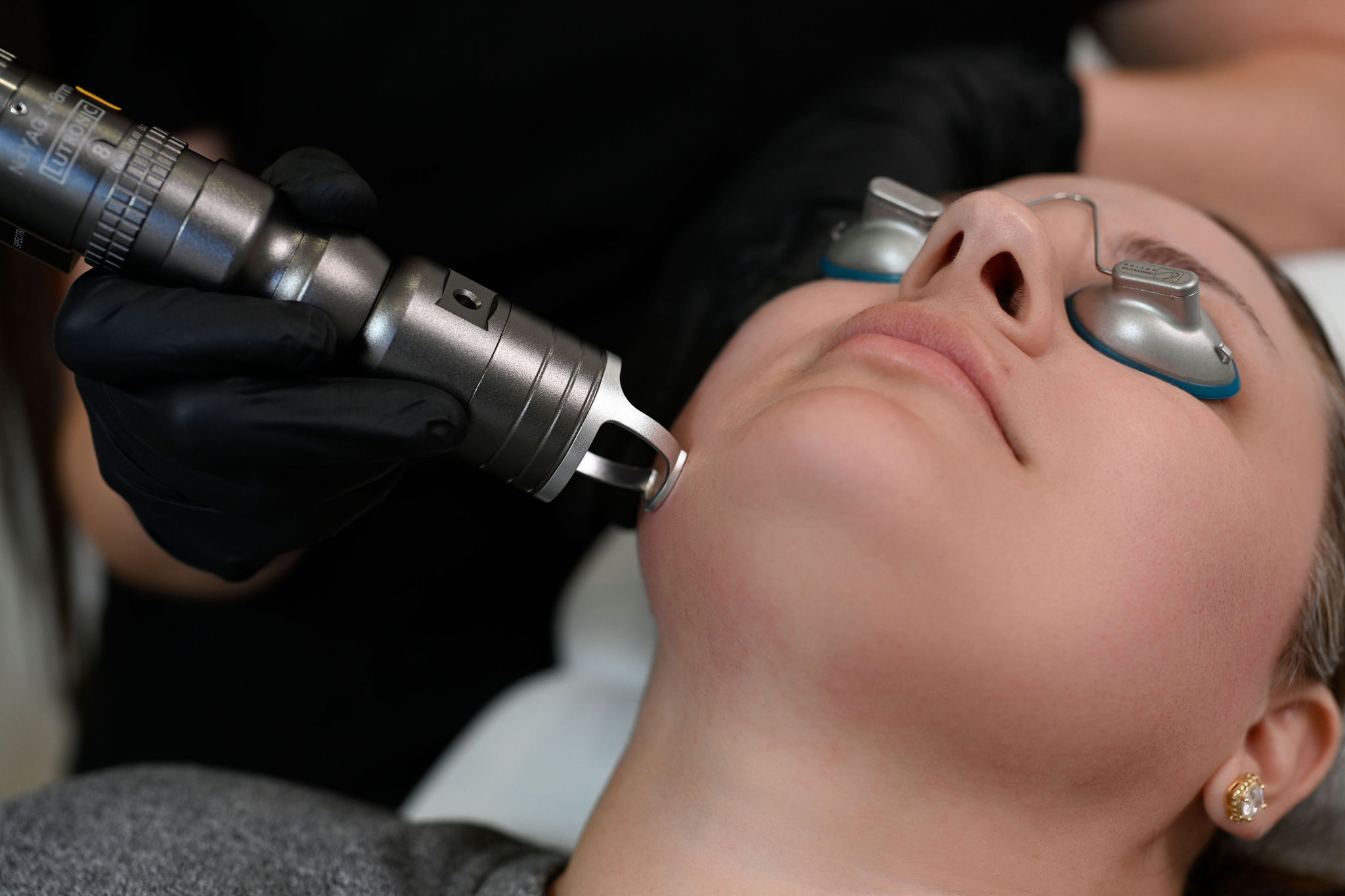 MDF Laser Toning treatment tip of Hollywood Spectra held to skin at Arnprior Med Spa
