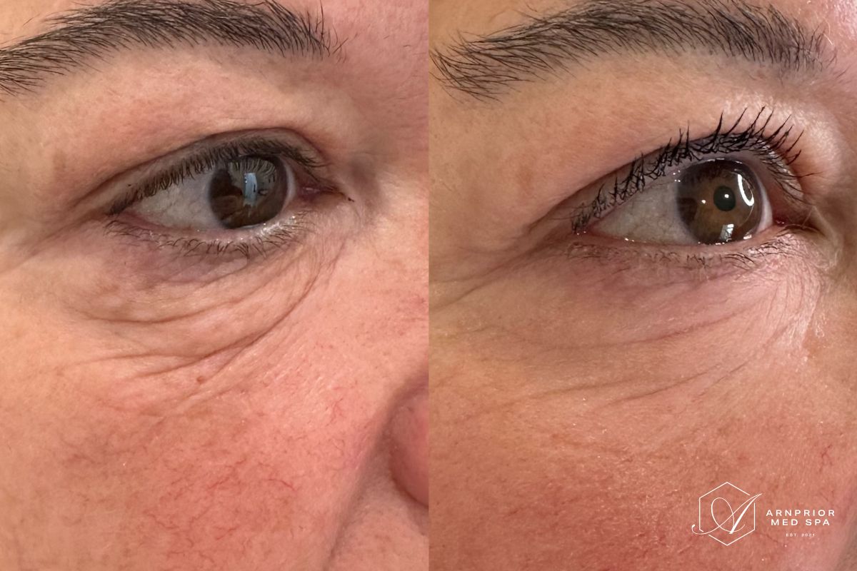 Undereye skin tightening improvement after 1 session of Plexr