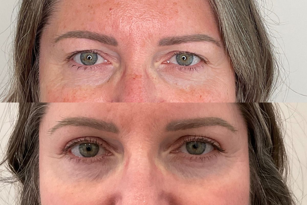 Upper lid non surgical blepharoplasty with Plexr after 1st session