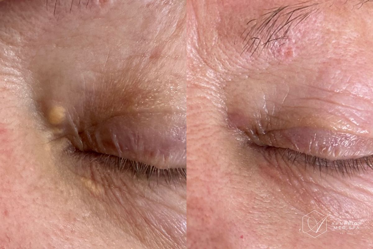 Xanethelasma removal on upper eyelid with Plexr plasma device