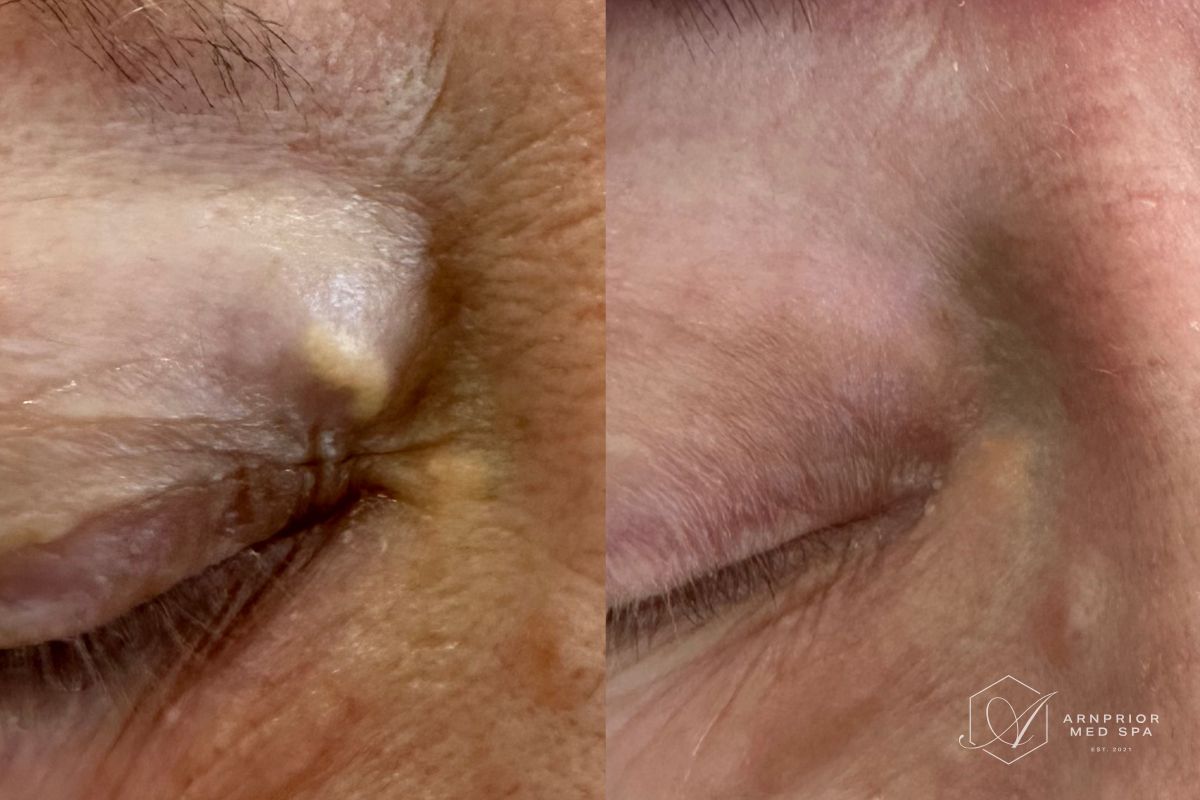Xanethelasma removal on upper eyelid with Plexr plasma device