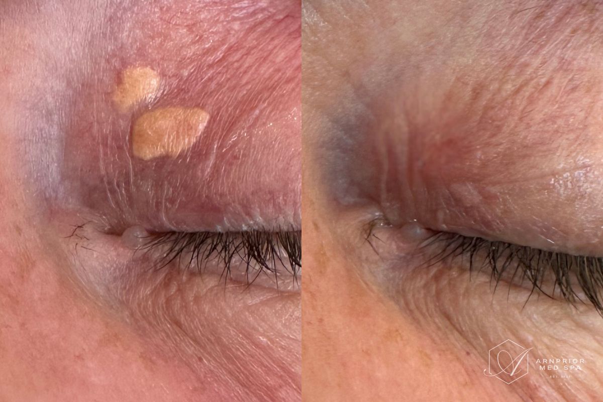Xanthelasma removal on upper eyelid with Plexr plasma device