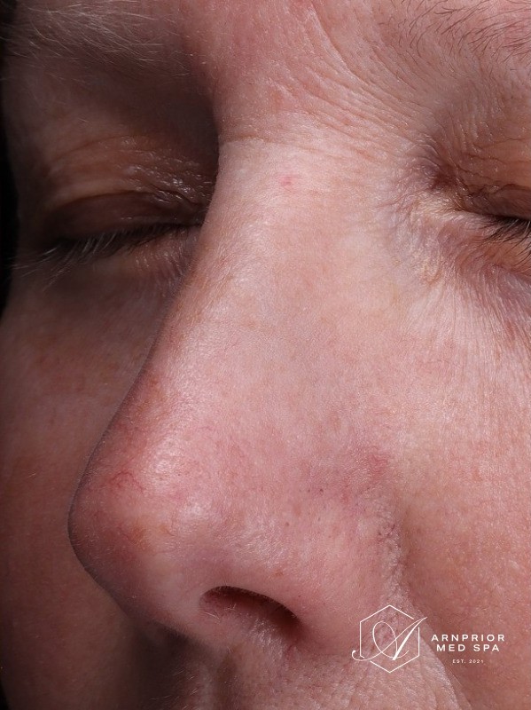Treatment result at Arnprior Med Spa, after