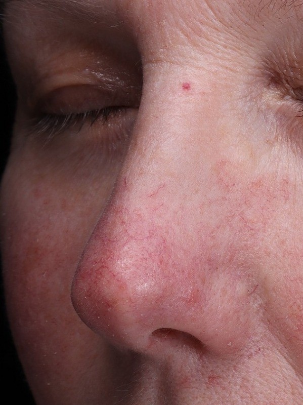 Treatment result at Arnprior Med Spa, before