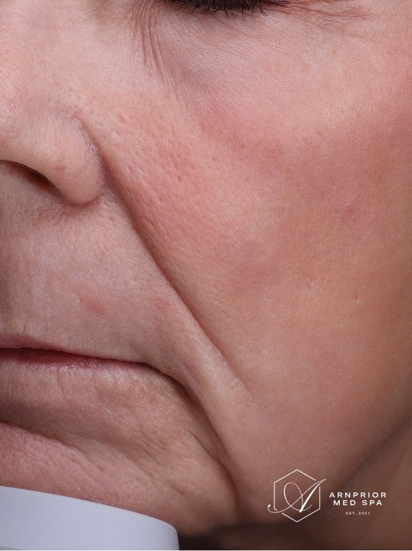 Facial texture and fine lines after CO2 laser resurfacing at Arnprior Med Spa