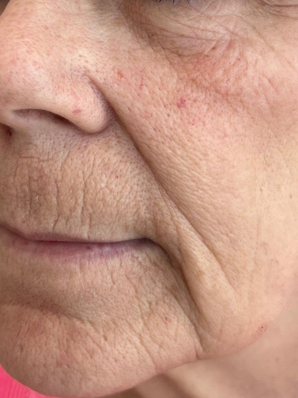 Facial texture and fine lines before CO2 laser resurfacing at Arnprior Med Spa