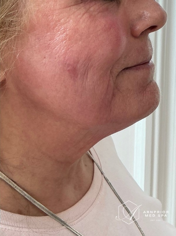 RF Skin Tightening, after