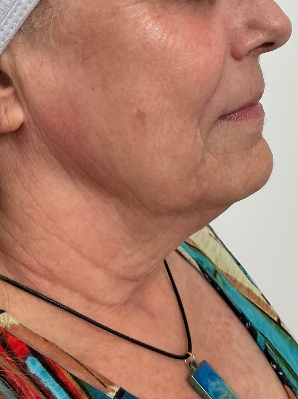 RF Skin Tightening, before