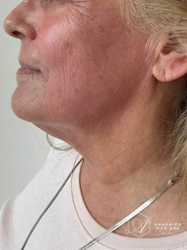 Genius Skin Tightening, after