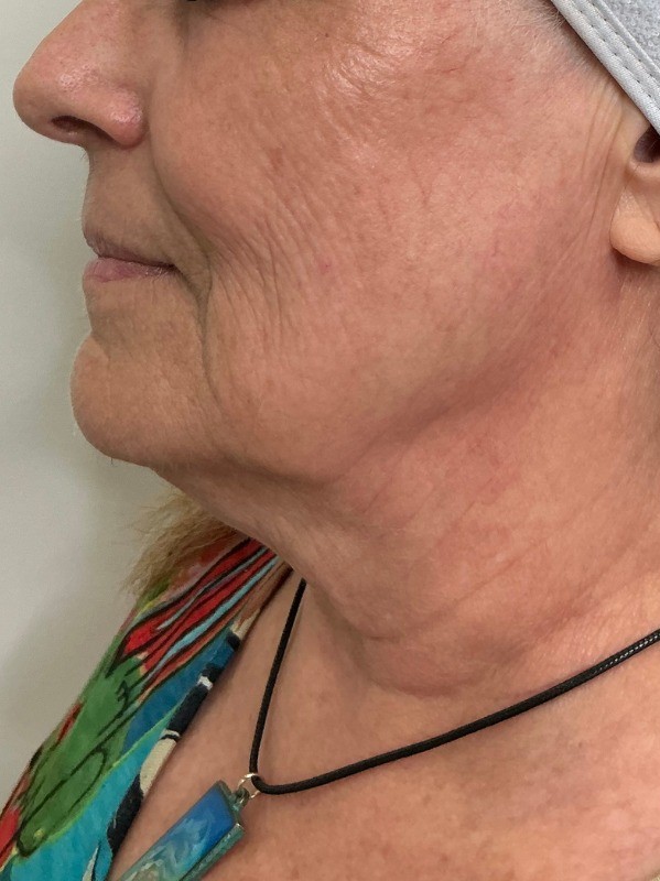 Genius Skin Tightening, before