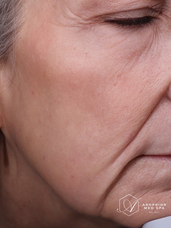 Facial texture after CO2 laser resurfacing