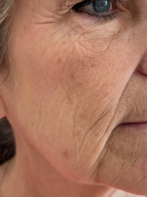 Facial texture before CO2 laser resurfacing
