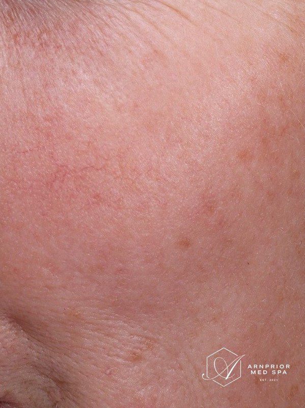 after, clearing of dense broken capillaries on the cheek, Arnprior Med Spa
