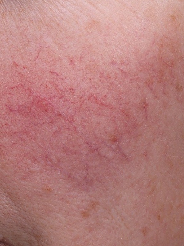 before, clearing of dense broken capillaries on the cheek, Arnprior Med Spa