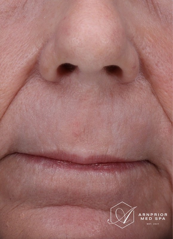 Perioral texture after CO2 laser resurfacing