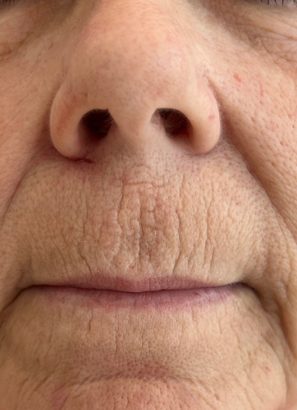 Perioral texture before CO2 laser resurfacing
