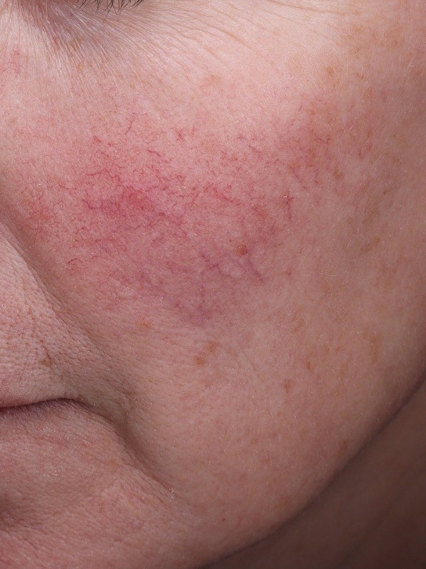 Treatment result at Arnprior Med Spa, before