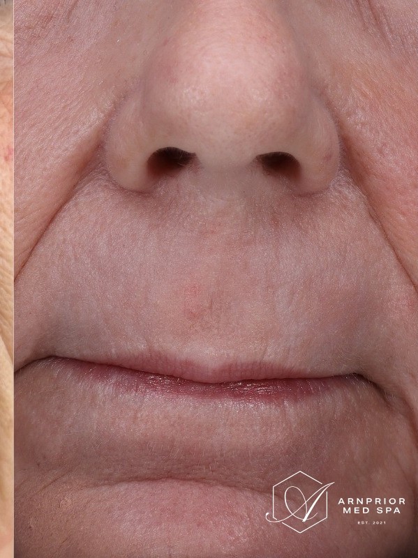 Perioral lines after CO2 laser resurfacing at Arnprior Med Spa