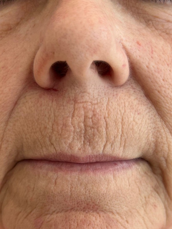 Perioral lines before CO2 laser resurfacing at Arnprior Med Spa