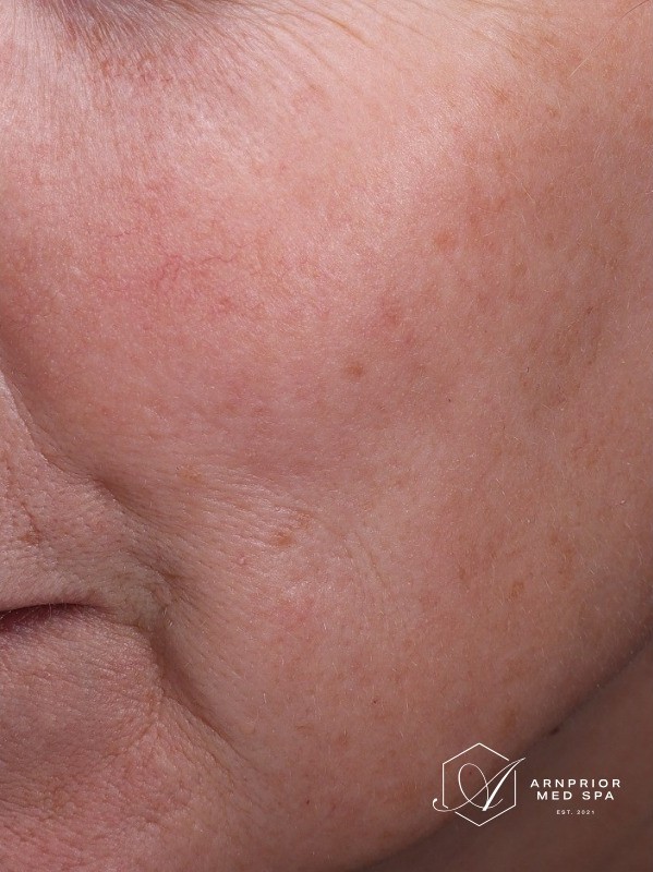 after, calmer cheek and jawline with less facial flushing, Arnprior Med Spa