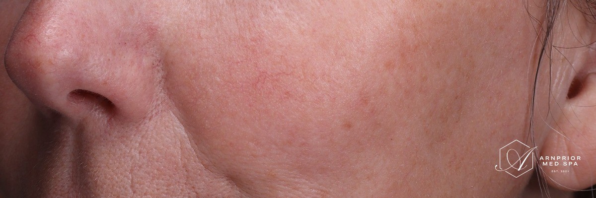 after, reduced redness around the nose and mid cheek, Arnprior Med Spa