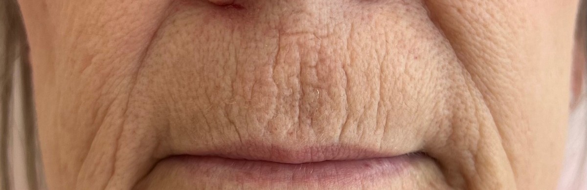 Perioral texture before CO2 laser resurfacing