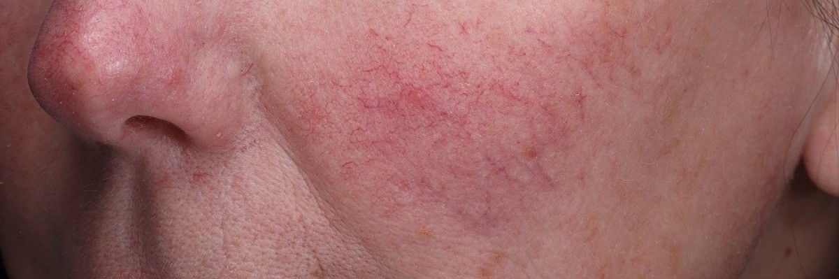 Treatment result at Arnprior Med Spa, before