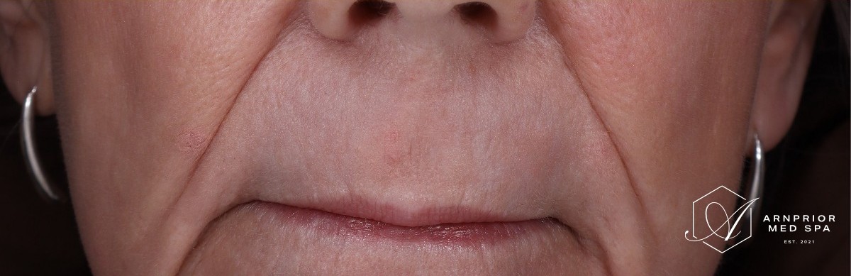 Perioral texture after CO2 laser resurfacing