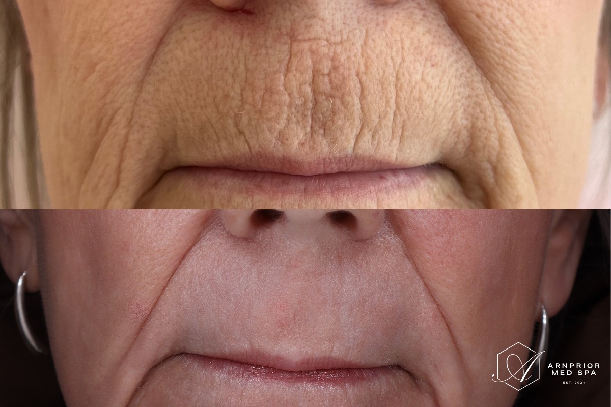 Perioral texture before and after CO2 laser resurfacing