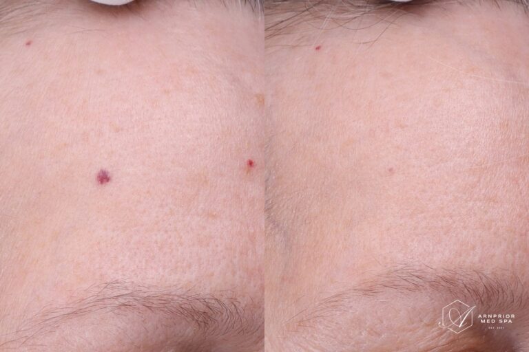 Rosacea and redness