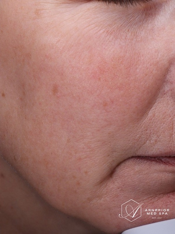 after, more even skin tone across the cheek and mouth area, Arnprior Med Spa