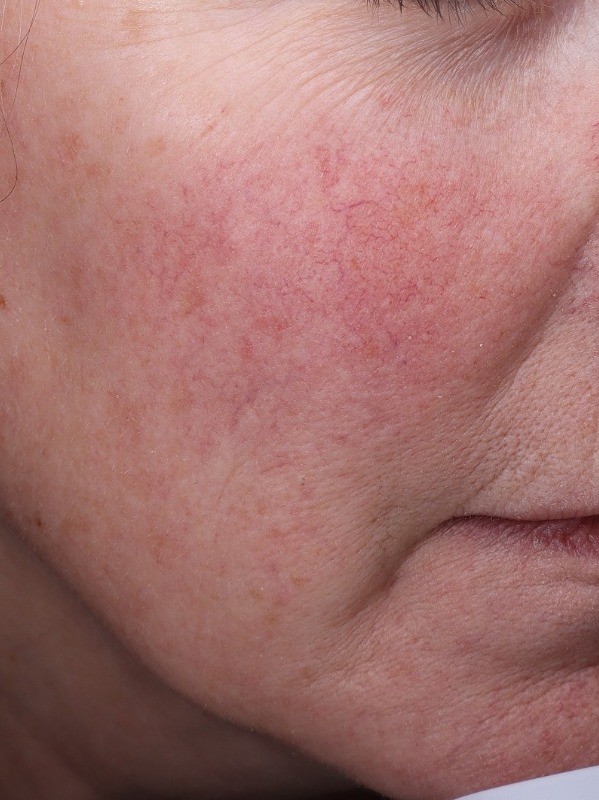 before, more even skin tone across the cheek and mouth area, Arnprior Med Spa