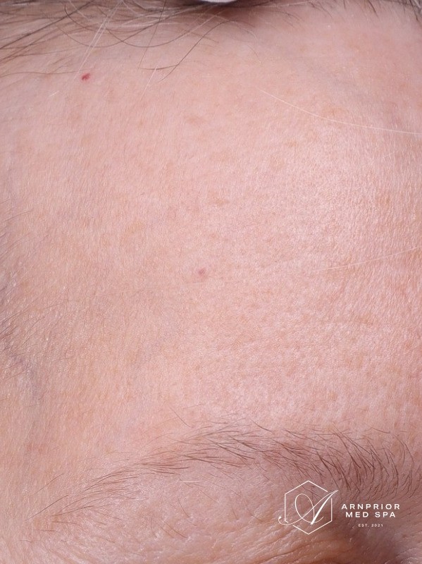 after six weeks of a ZO Skin Health routine, clearer forehead with fewer vascular marks, Arnprior Med Spa